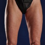SmartLipo Liposculpture of bilateral inner and outer thighs