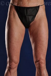 SmartLipo Liposculpture of bilateral inner and outer thighs