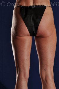 SmartLipo Liposculpture of bilateral inner and outer thighs