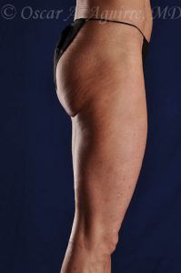 SmartLipo Liposculpture of bilateral inner and outer thighs