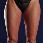 SmartLipo Liposculpture of bilateral inner and outer thighs