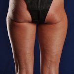 SmartLipo Liposculpture of bilateral inner and outer thighs