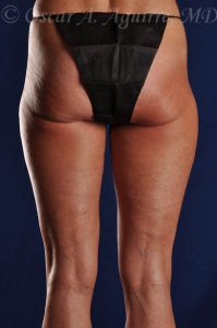 SmartLipo Liposculpture of bilateral inner and outer thighs