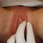 Postop Laser Reduction Labiaplasty