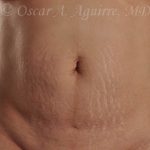 Postop CoolSculpting