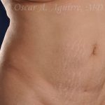 Postop CoolSculpting