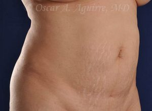 Postop CoolSculpting