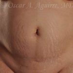 Preop CoolSculpting