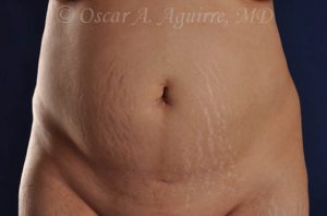 Preop CoolSculpting