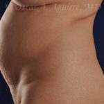 Preop CoolSculpting