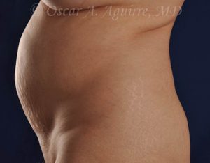 Preop CoolSculpting