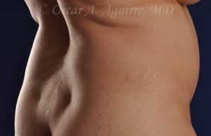 Preop CoolSculpting