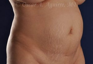 Preop CoolSculpting