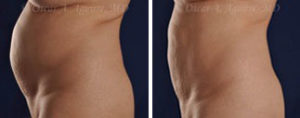 CoolSculpting before & after